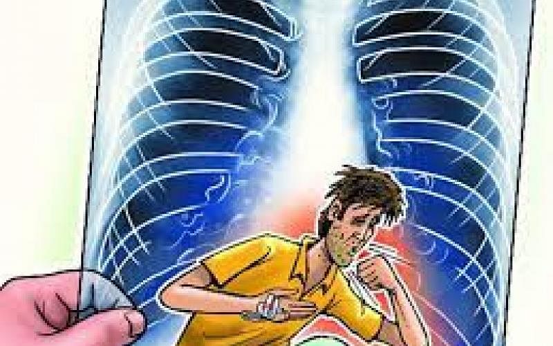 Tuberculosis– ವಿಶ್ವ ಕ್ಷಯರೋಗ ದಿನ 2022: ಈ ರೋಗ ಲಕ್ಷಣಗಳನ್ನು ನಿರ್ಲಕ್ಷಿಸಬೇಡಿ