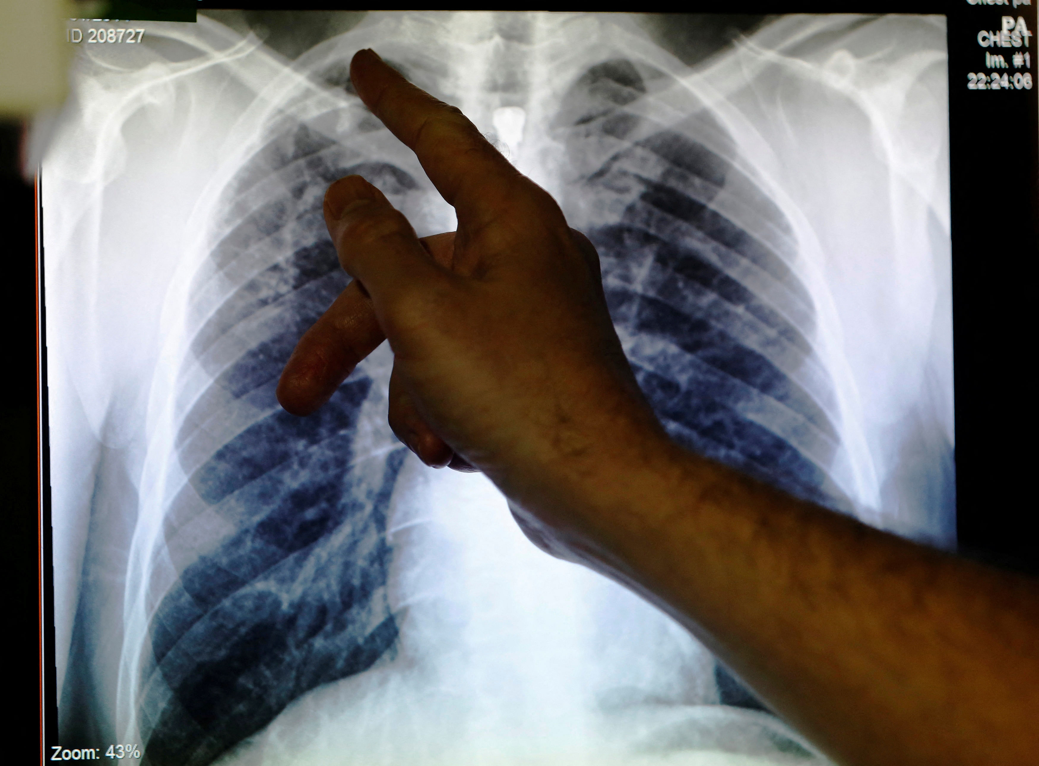 <div class="paragraphs"><p>FILE PHOTO: Clinical lead Doctor Al Story points to an x-ray showing a pair of lungs infected with TB  during an interview with Reuters  on board the mobile X-ray unit screening </p></div>